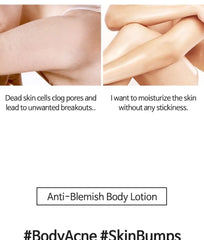 Anti Blemish Body Lotion Back & Chest 2pcs Bundle Set