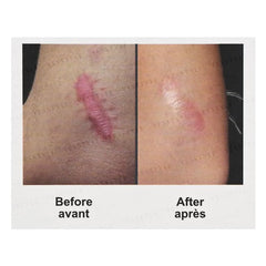 Scar Treatment
