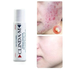 M Acne Water